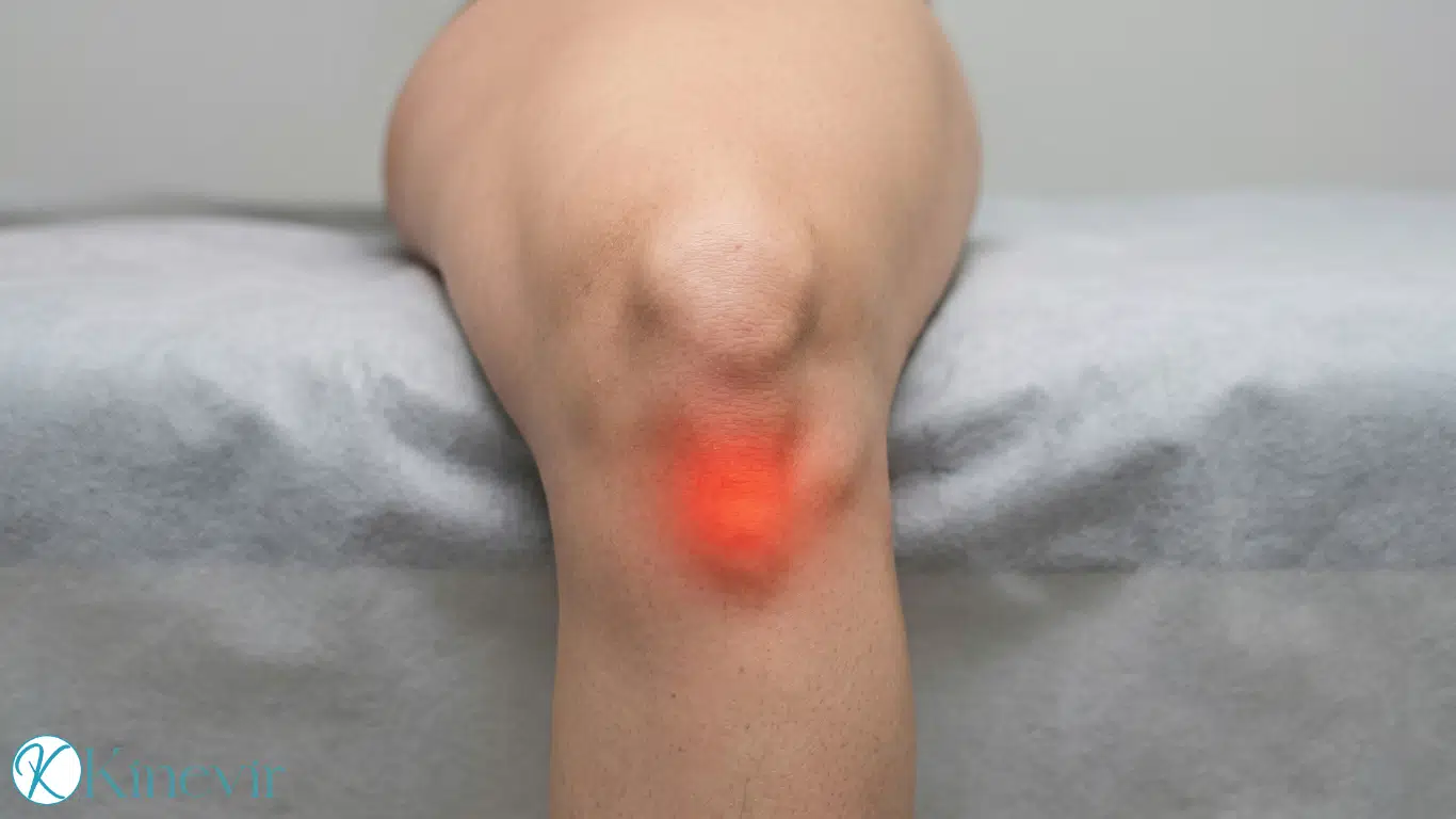 Douleur localisée sous la rotule dans la tendinopathie rotulienne